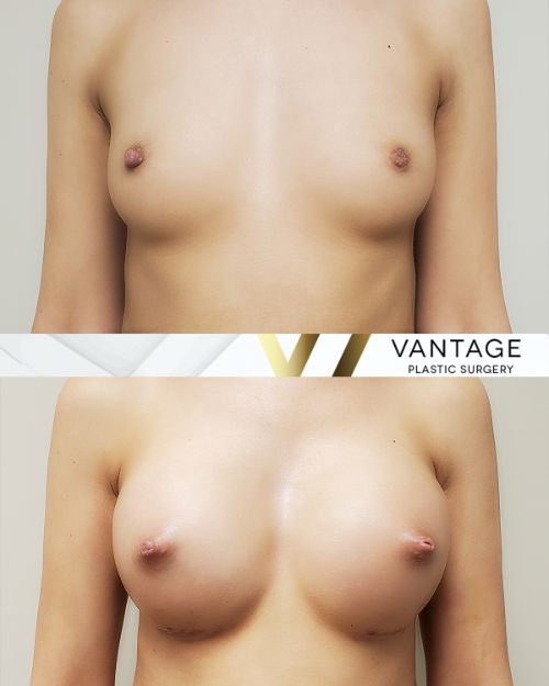 Before and after photo of Breast augmentation