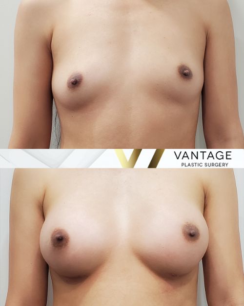 Before and after photo of Breast augmentation