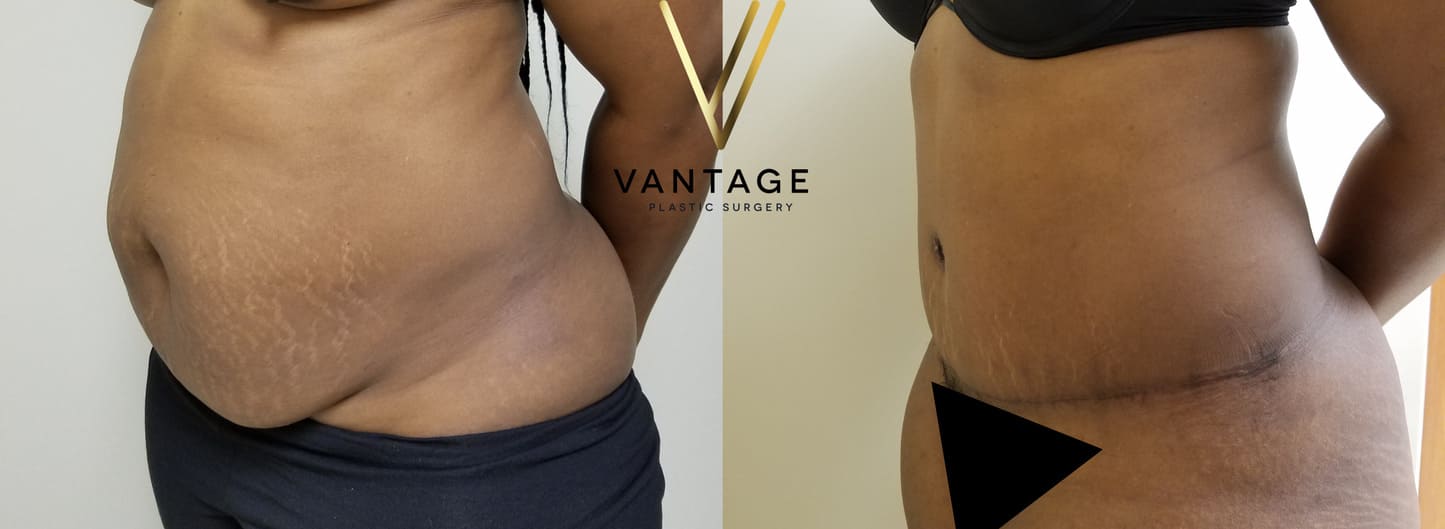 Before and After - Abdominoplasty