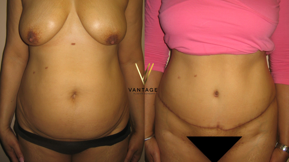 Abdominoplasty 05 01