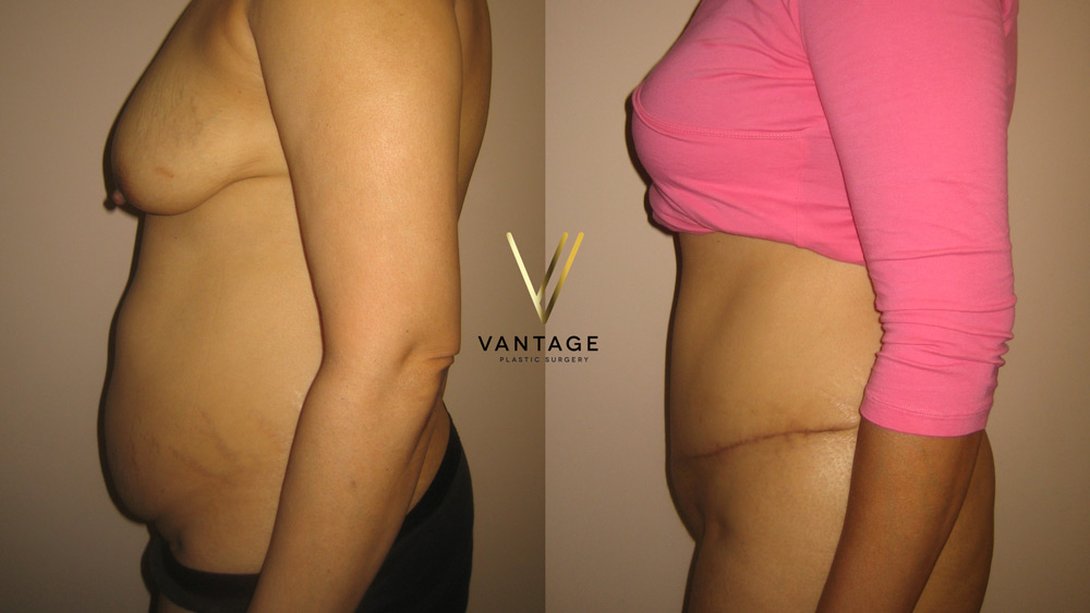 Abdominoplasty 05 02