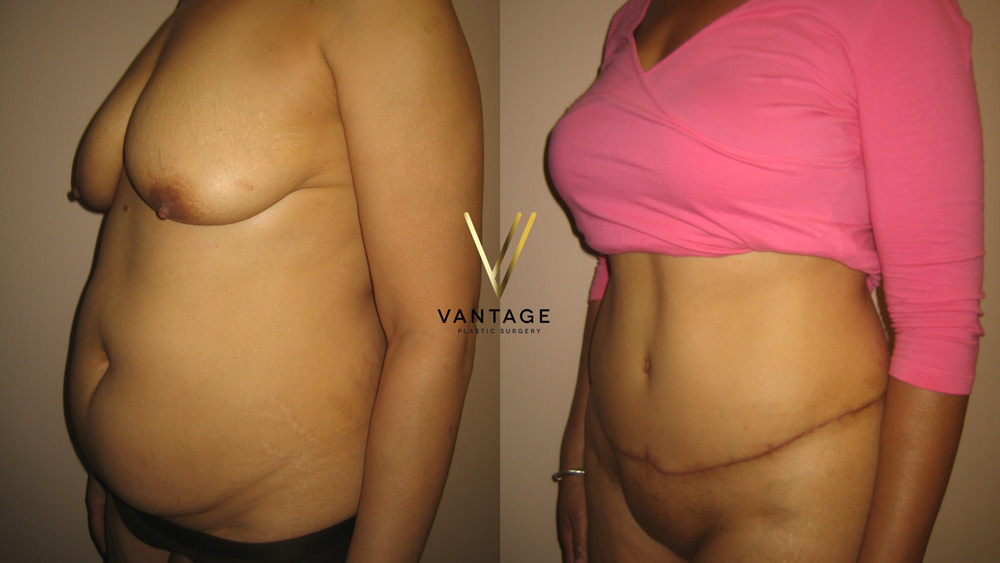 Abdominoplasty 05 03
