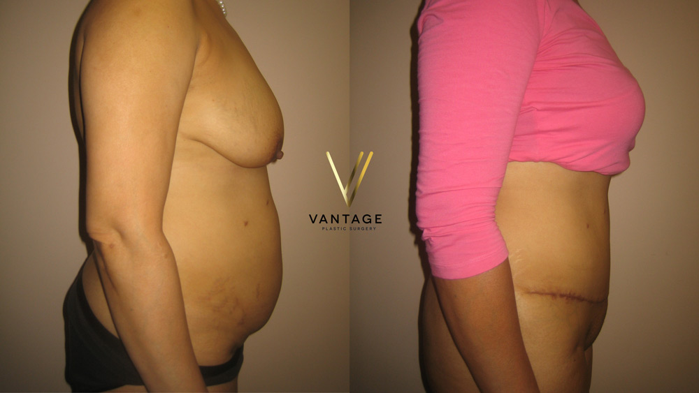 Abdominoplasty 05 04