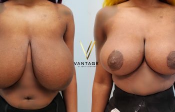 Breast Reduction 06 01
