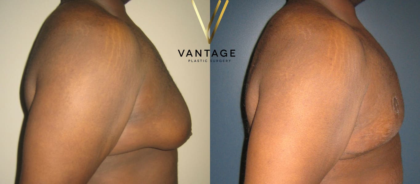 Before and After - Breast Plastic Surgery