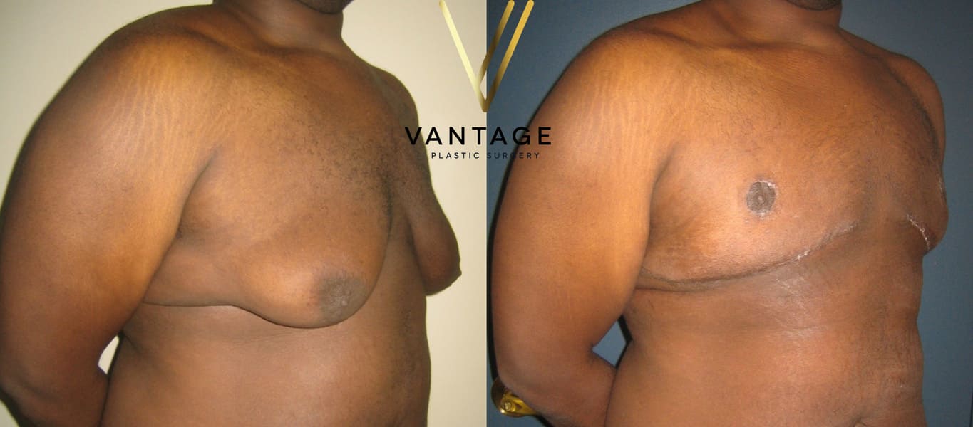 Before and After - Breast Plastic Surgery
