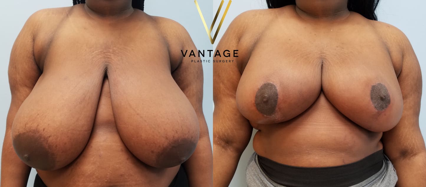 Before and After - Breast Reduction