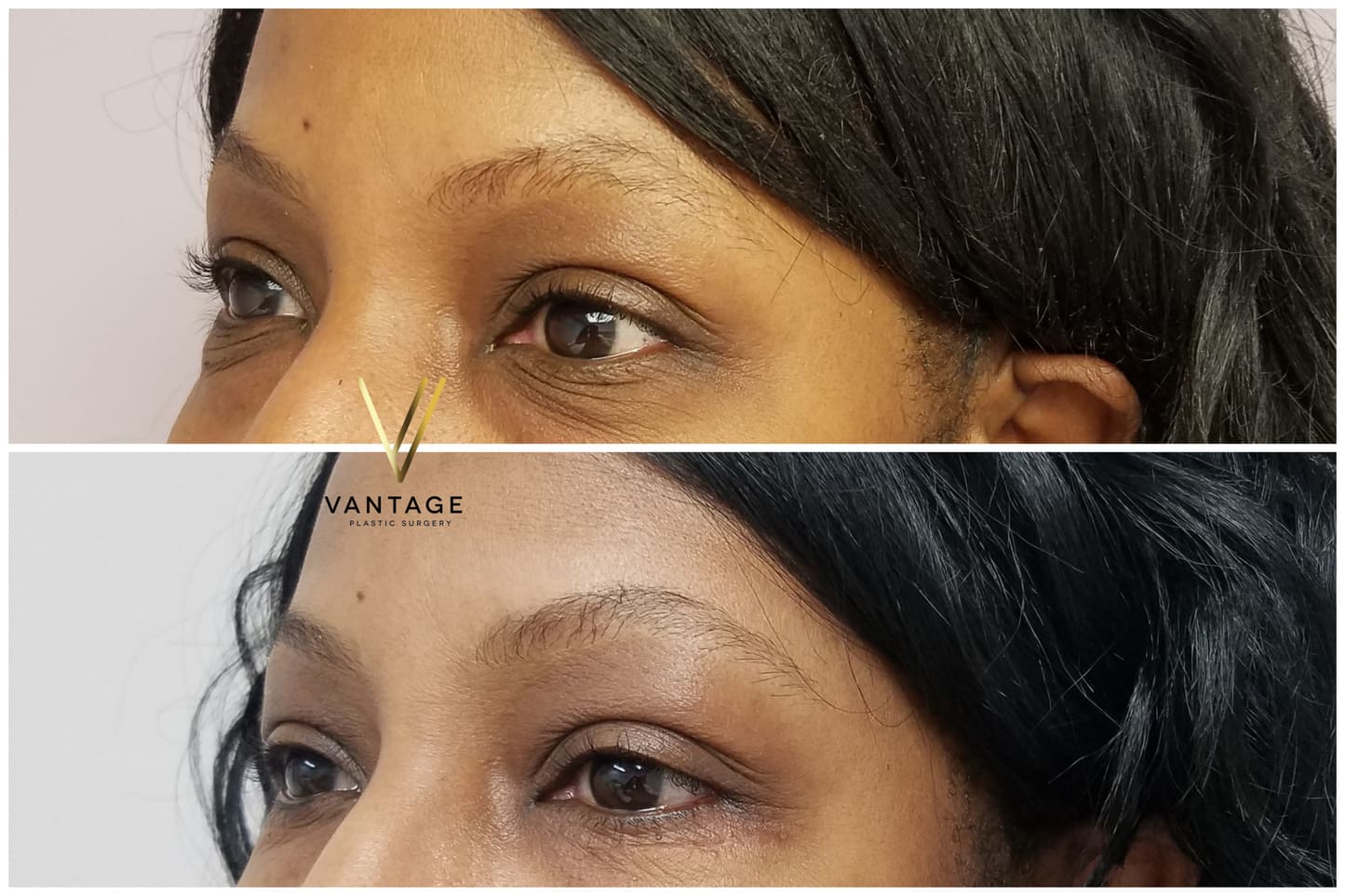 Before and After - Eyelid Surgery