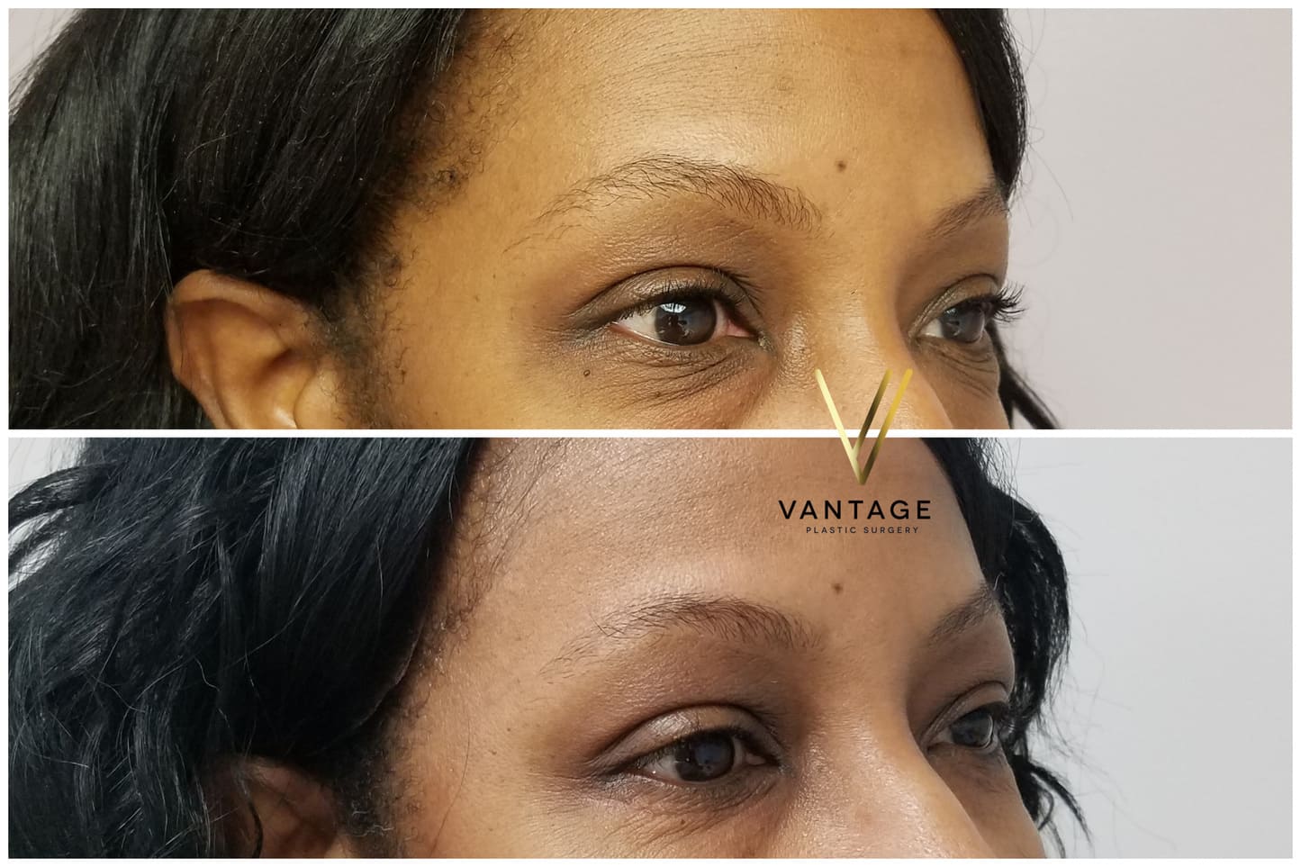 Before and After - Eyelid Surgery