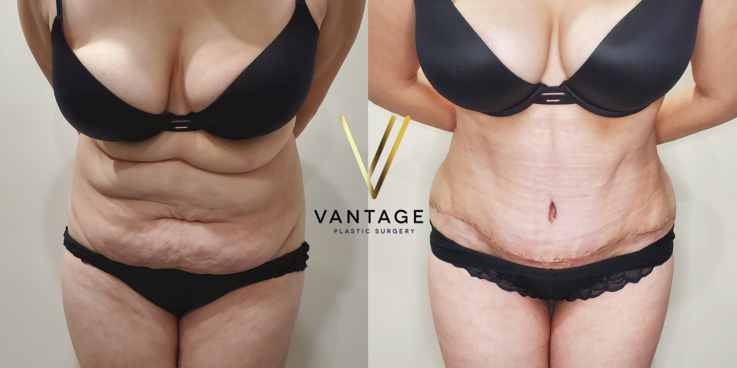 before and after Abdominoplasty