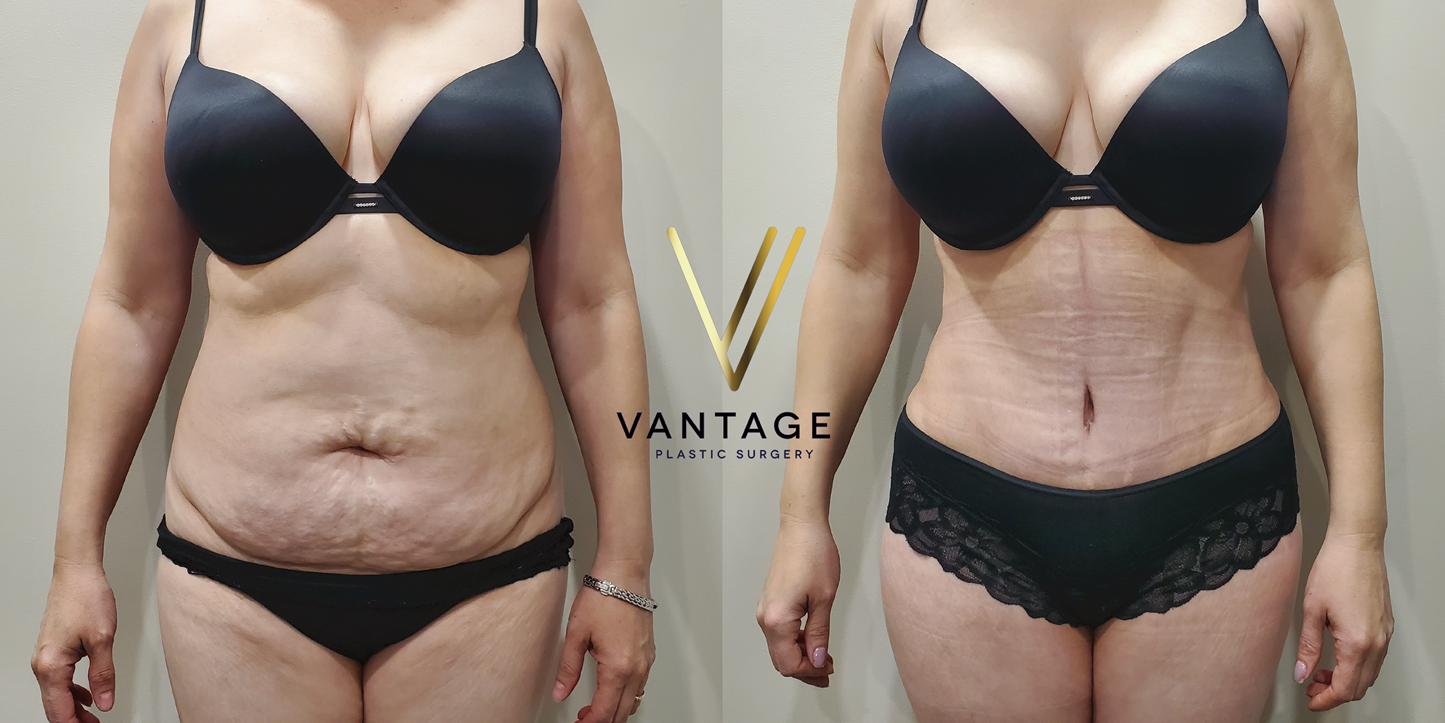 before and after Abdominoplasty