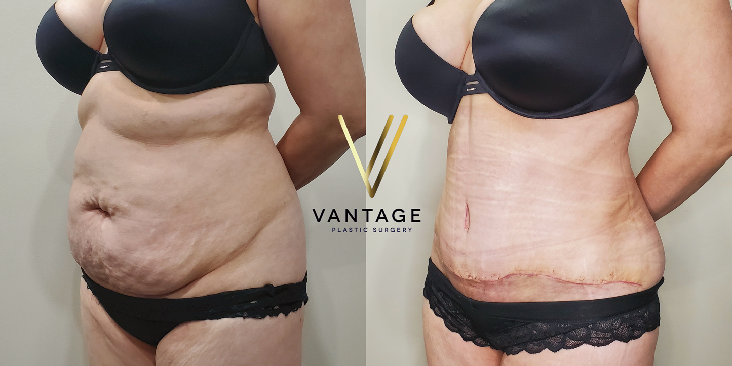 before and after Abdominoplasty