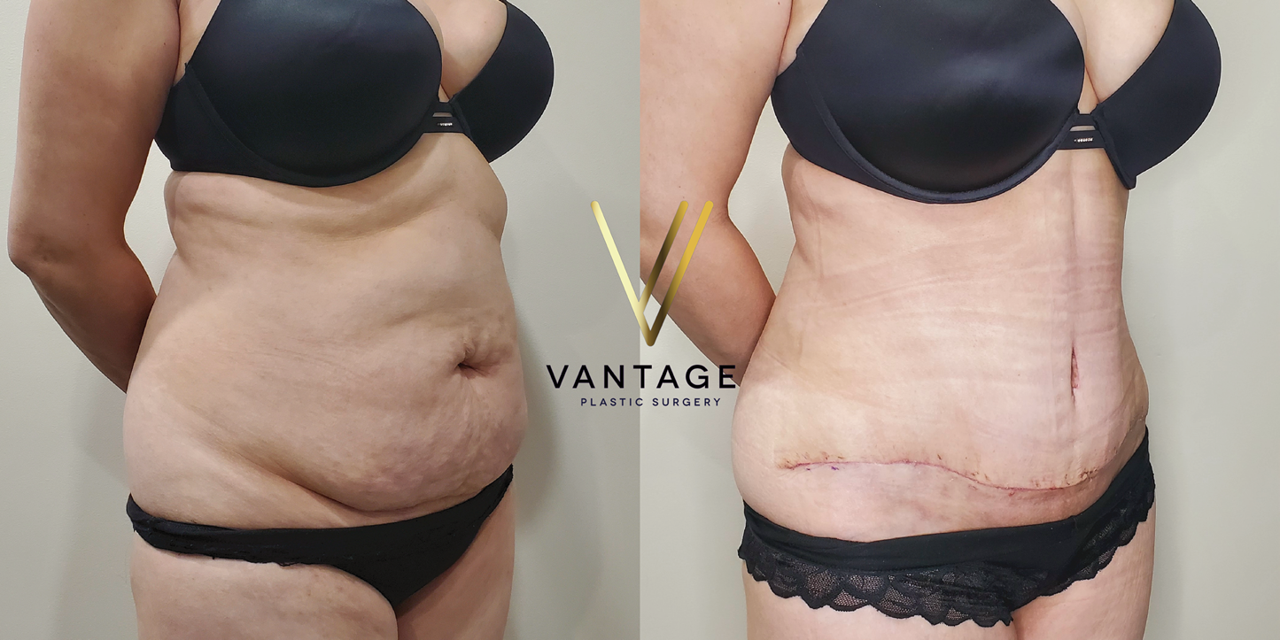 before and after Abdominoplasty