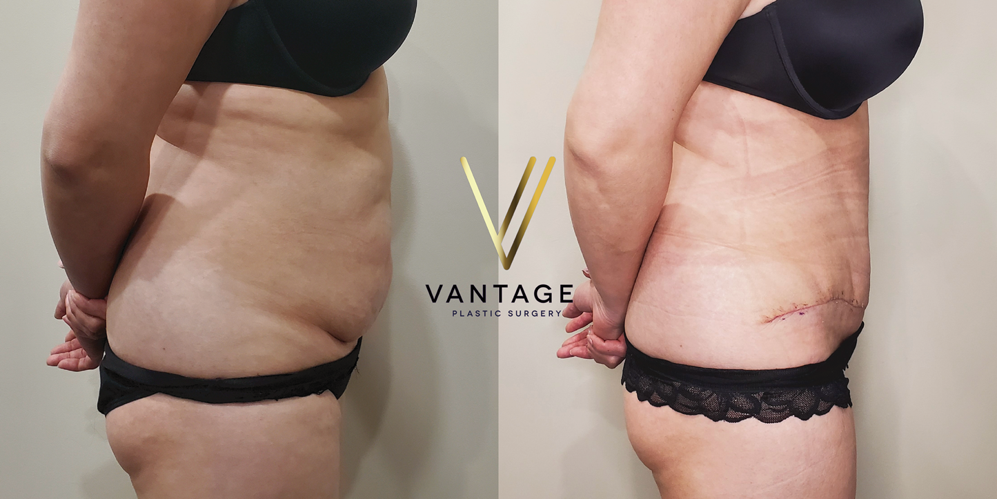 before and after Abdominoplasty