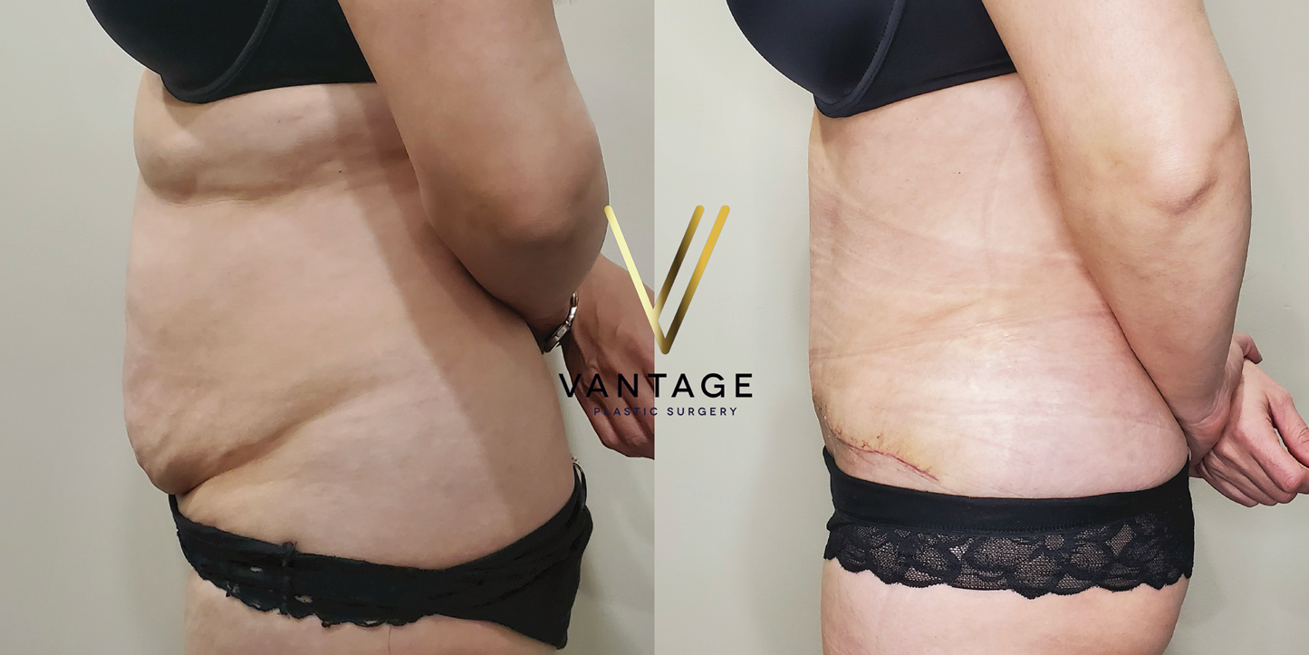 before and after Abdominoplasty