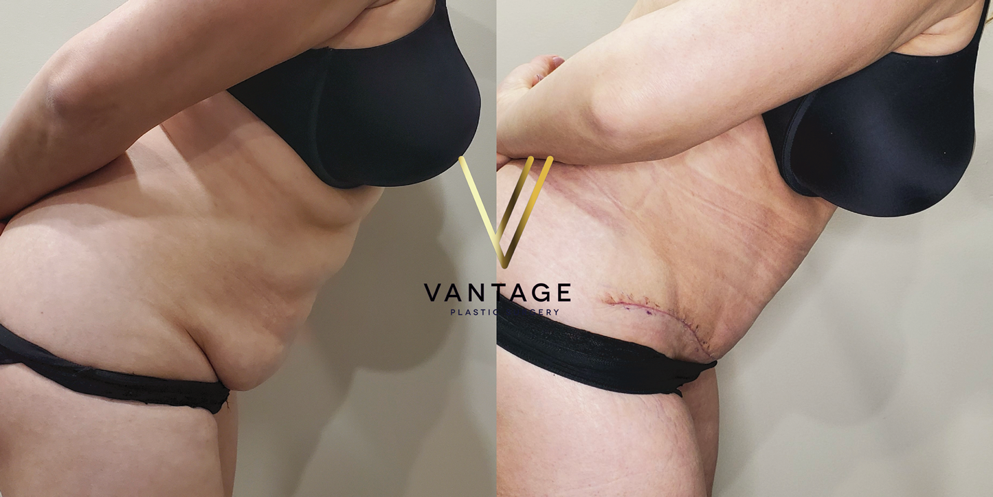 before and after Abdominoplasty