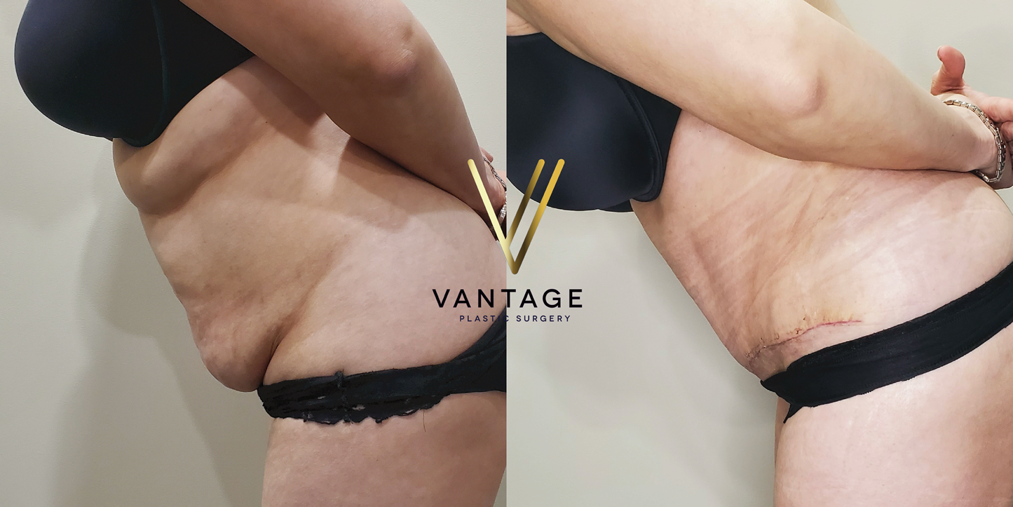 before and after Abdominoplasty