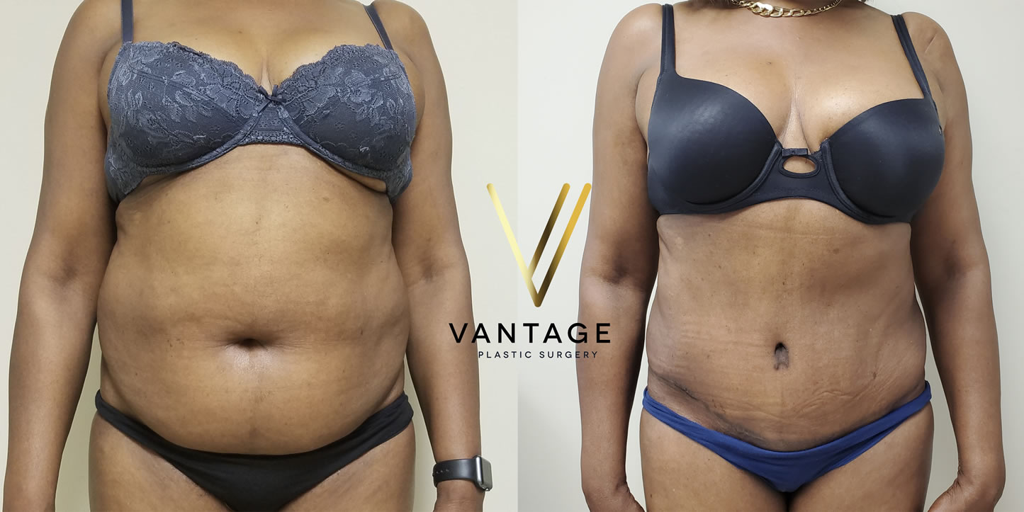 before and after Abdominoplasty