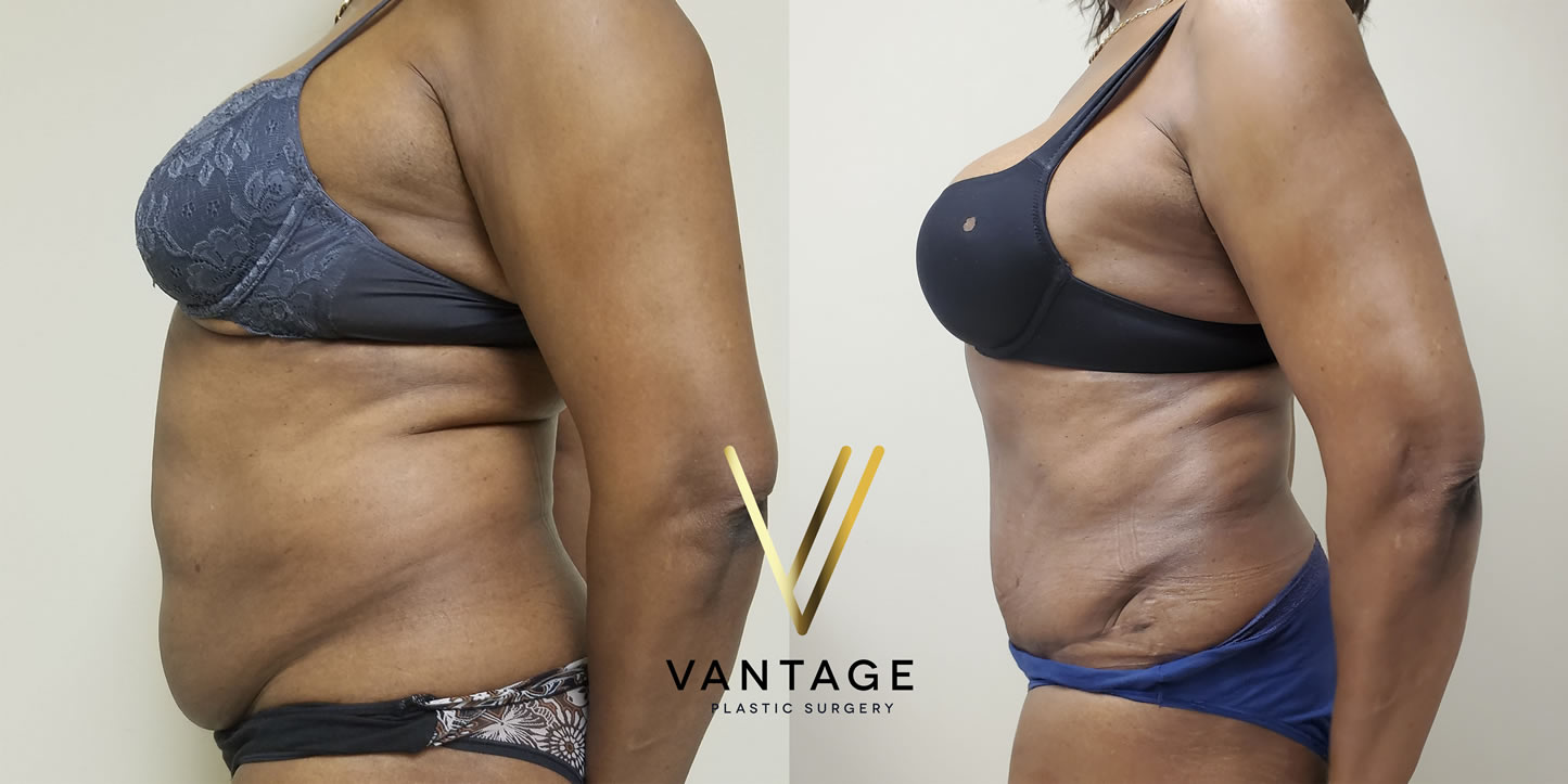 before and after Abdominoplasty