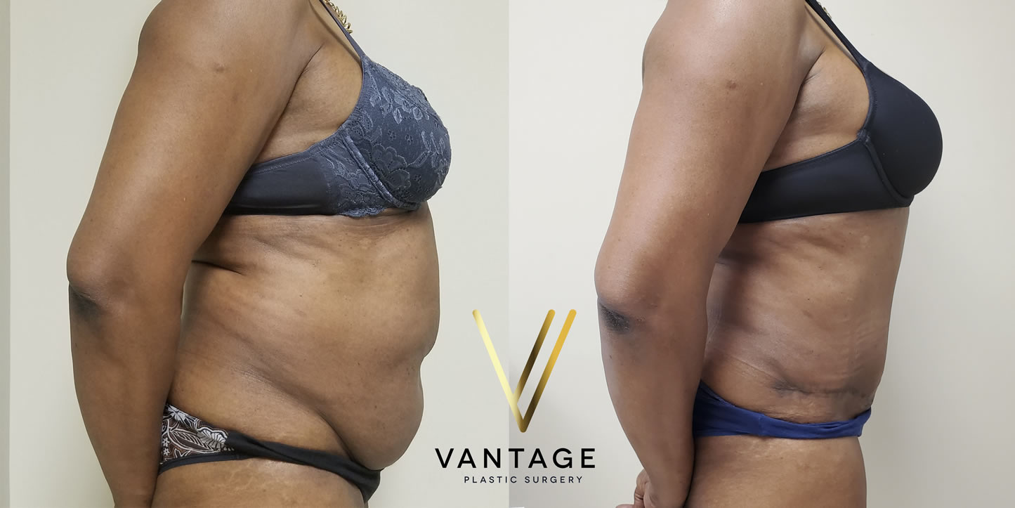 before and after Abdominoplasty