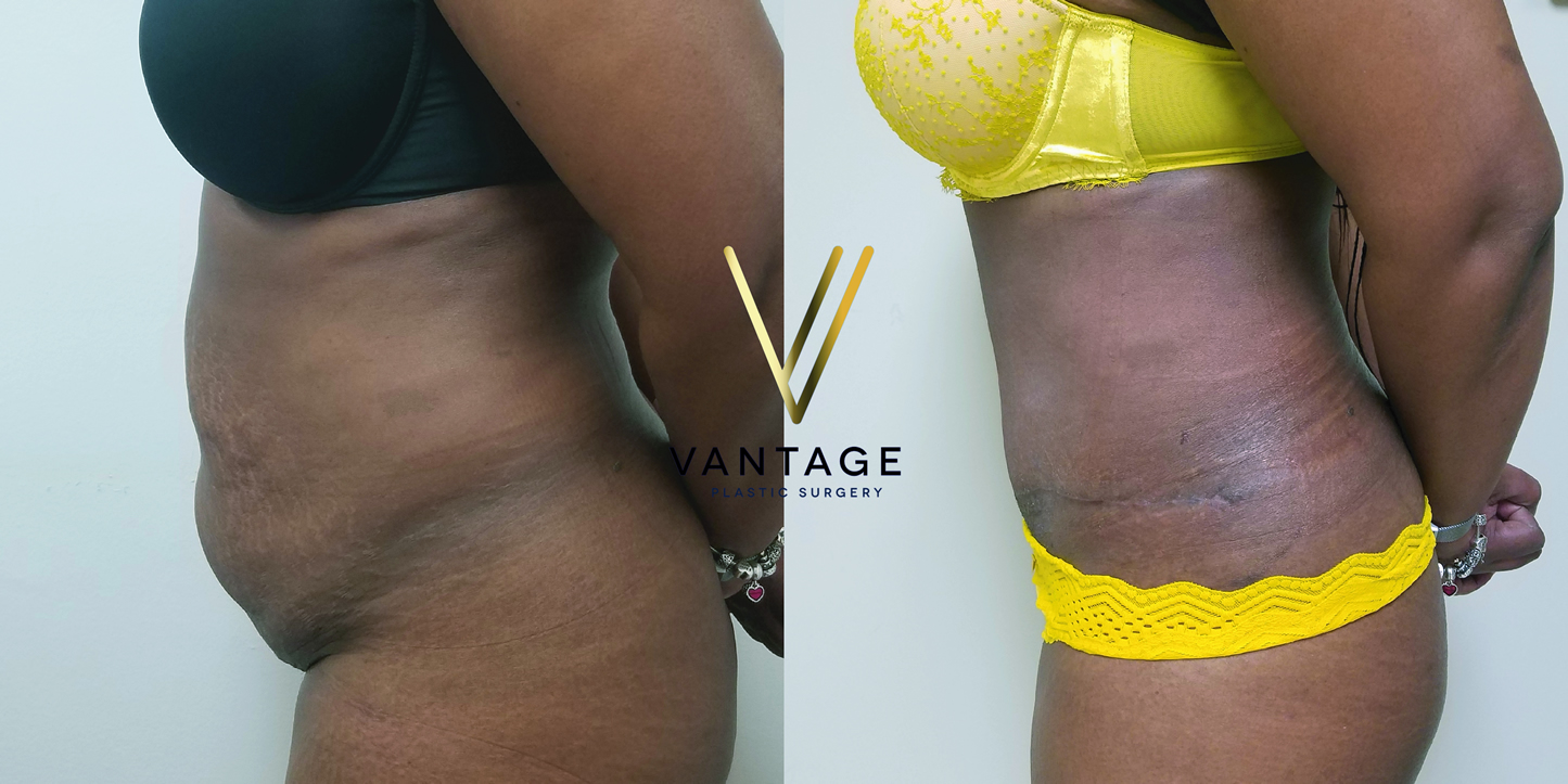 before and after Abdominoplasty