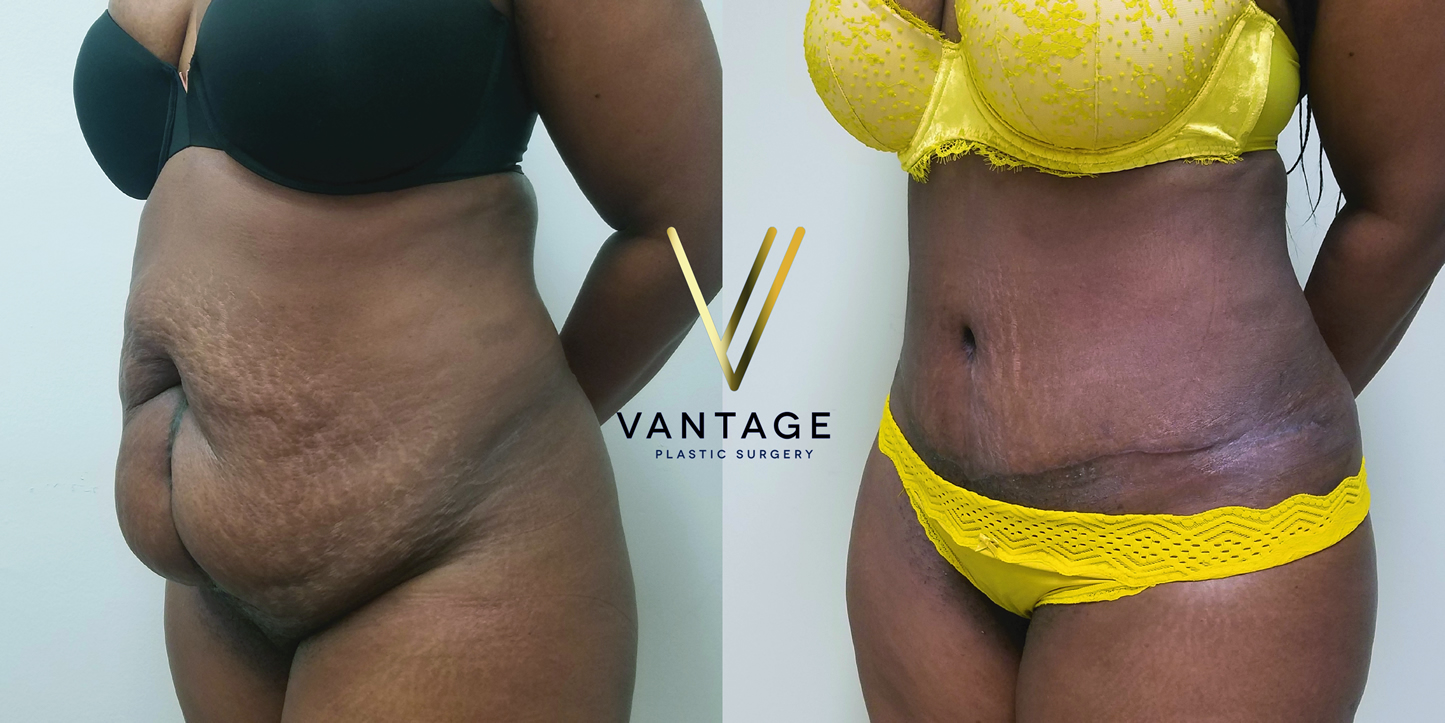 before and after Abdominoplasty