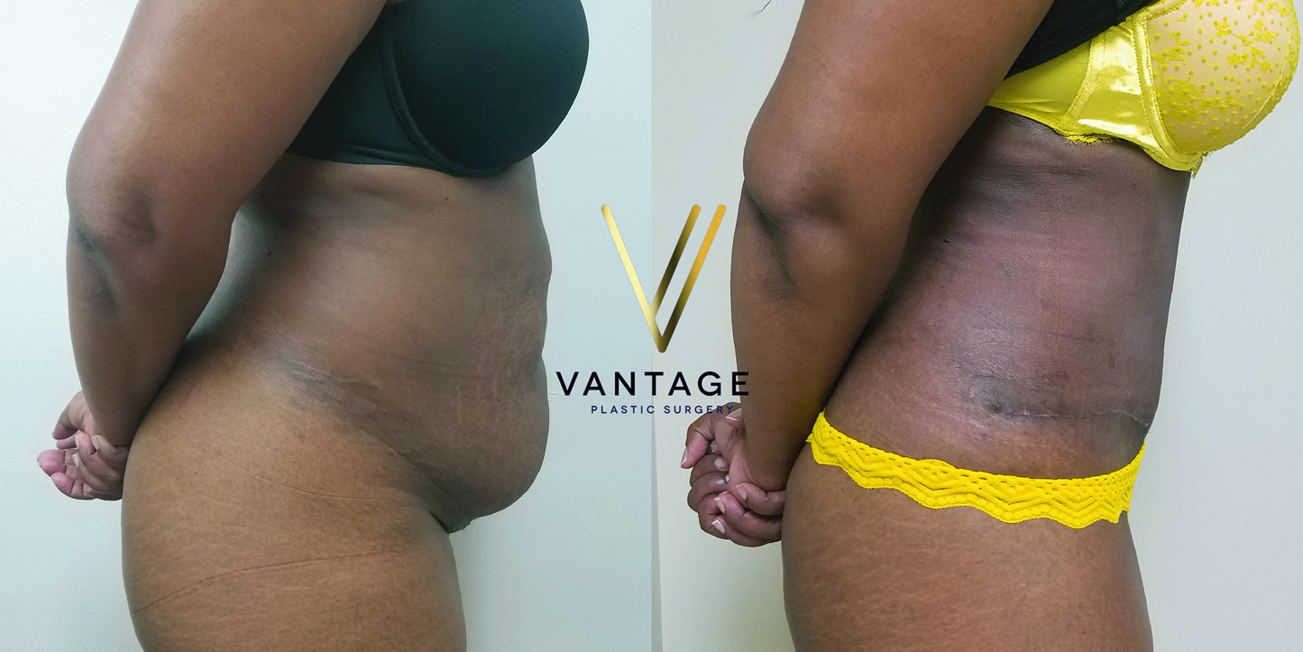 before and after Abdominoplasty