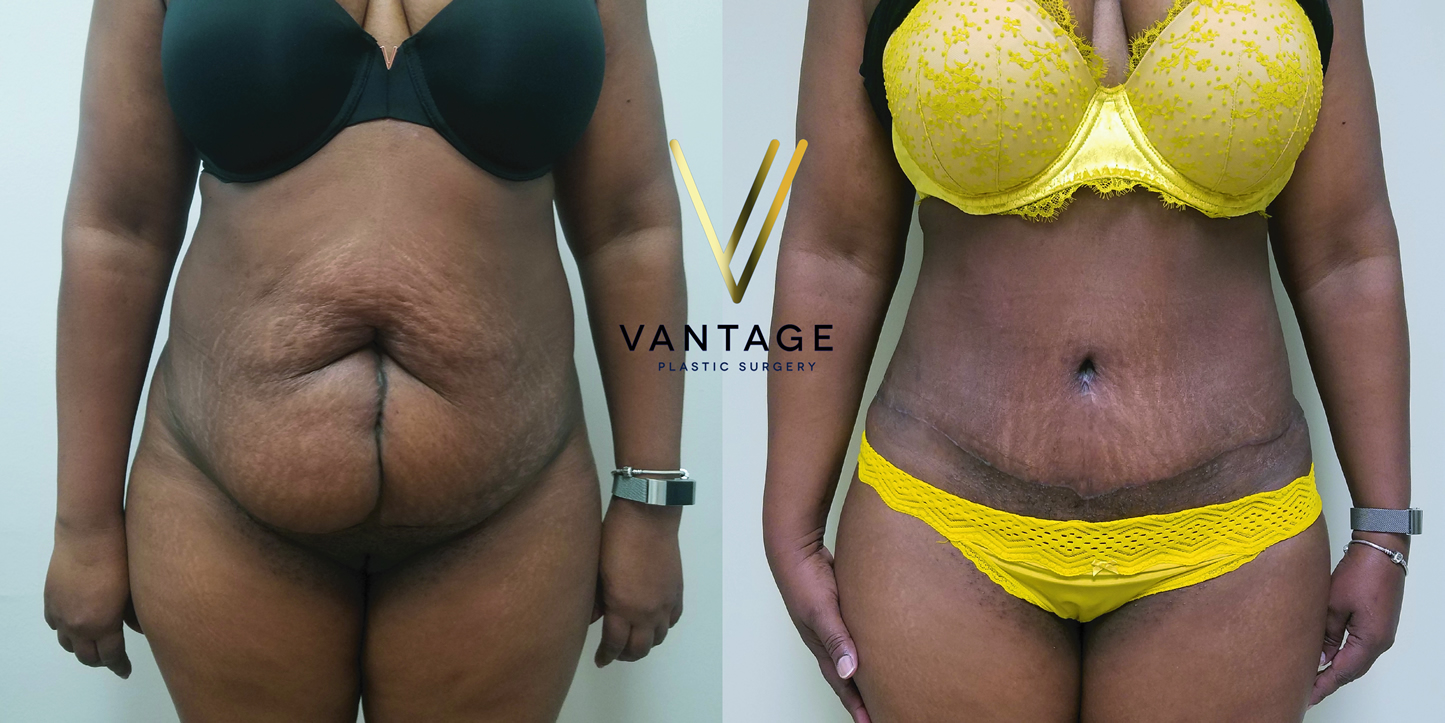 before and after Abdominoplasty