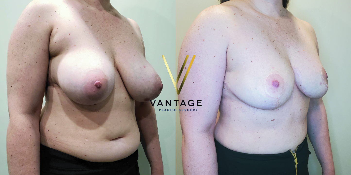 before and after breast reduction