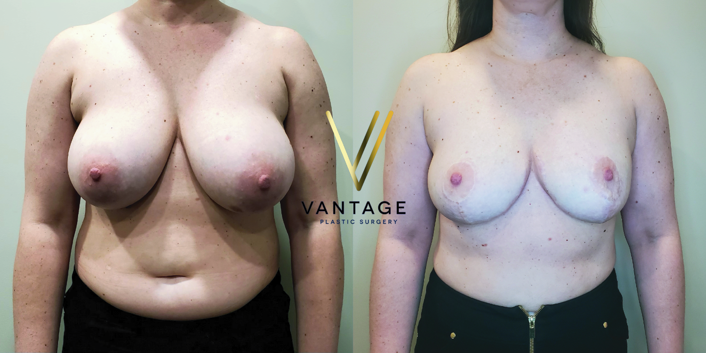 before and after breast reduction
