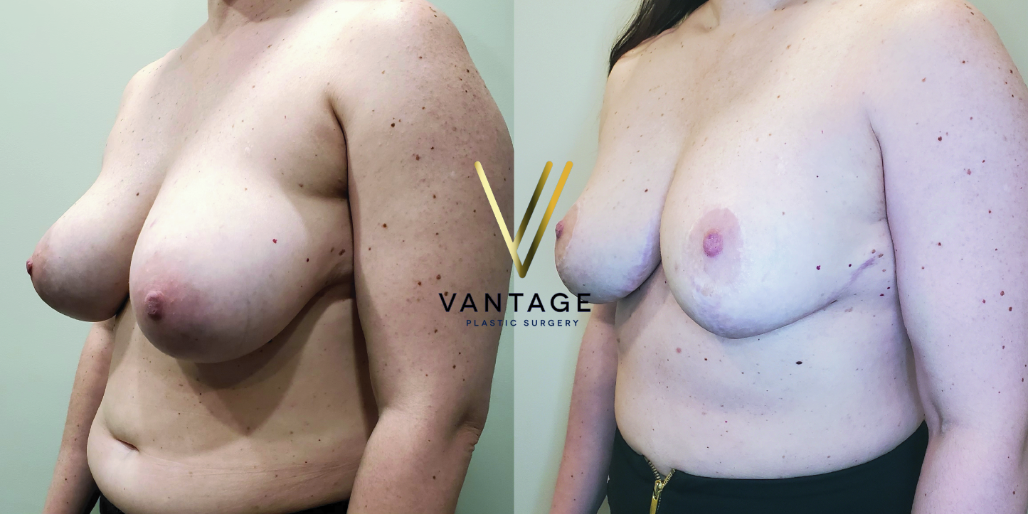 before and after breast reduction