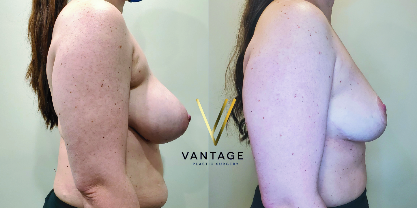 before and after breast reduction