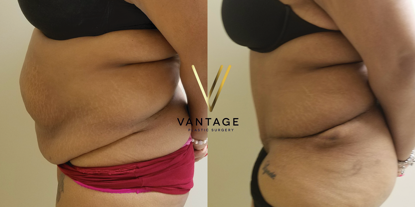 before and after Abdominoplasty