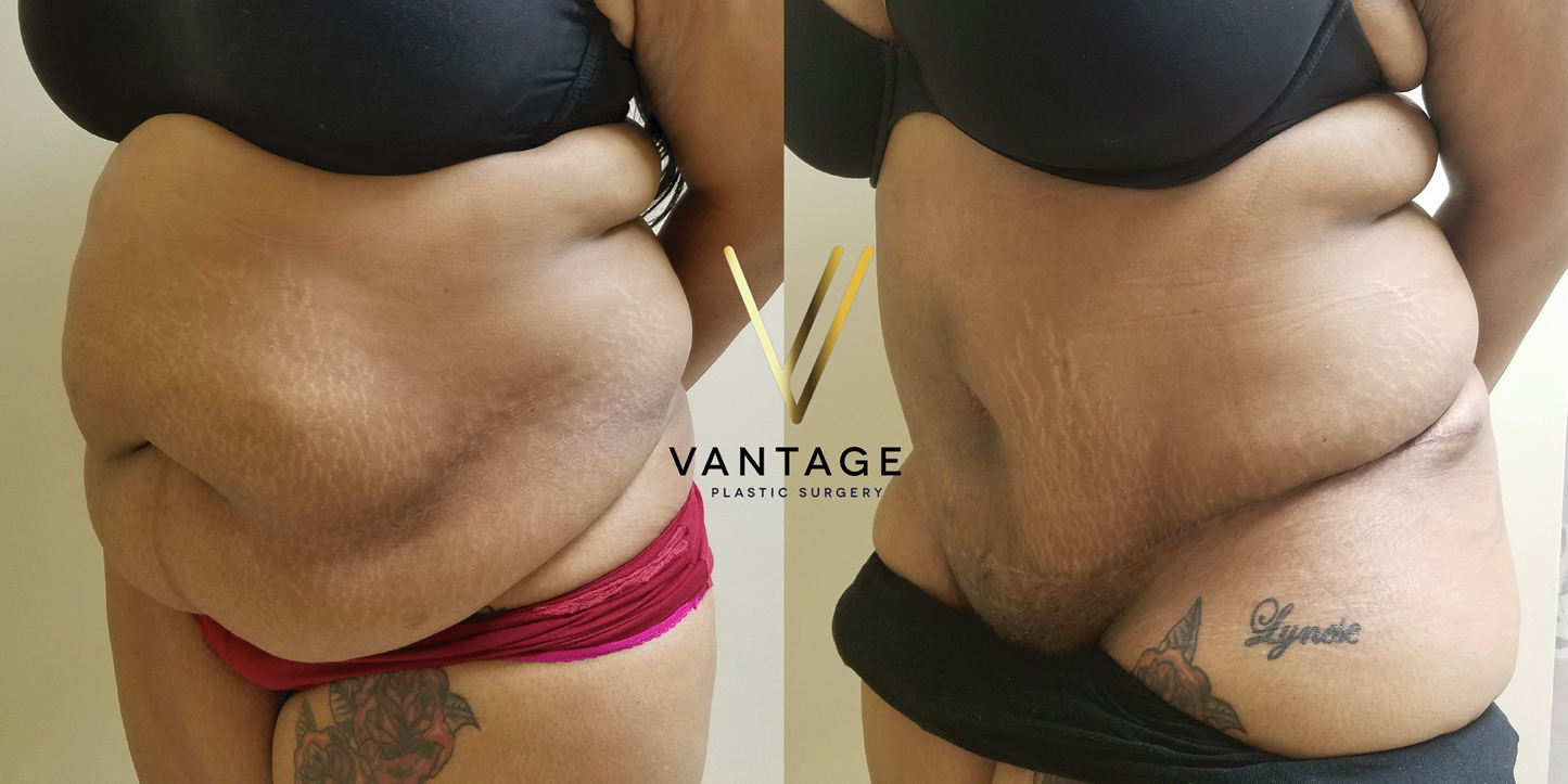 before and after Abdominoplasty