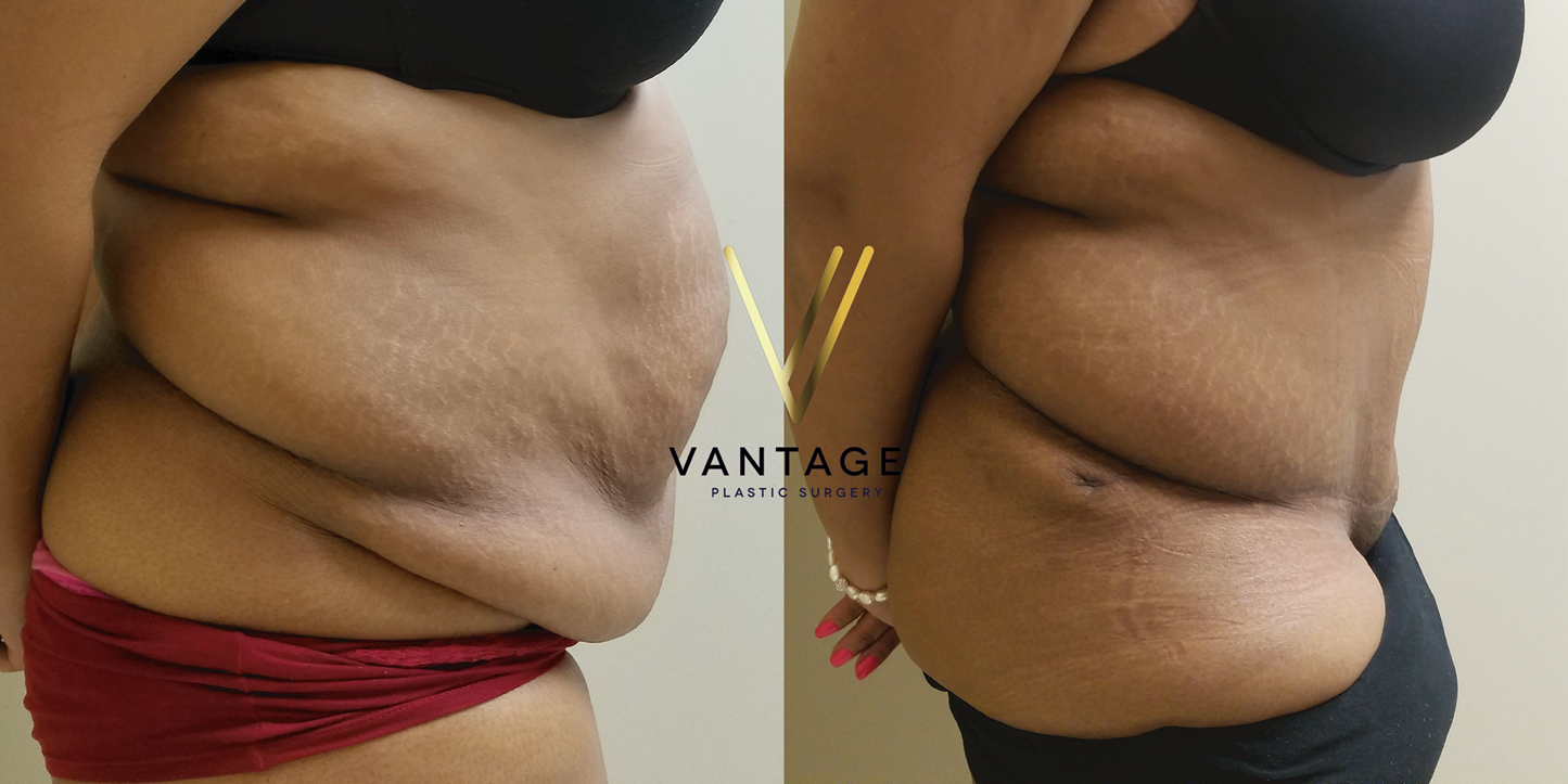 before and after Abdominoplasty