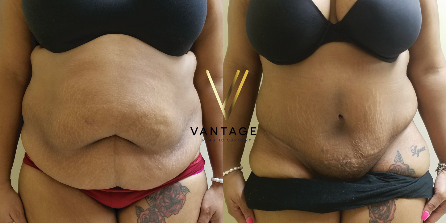 before and after Abdominoplasty