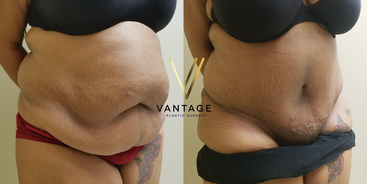 before and after Abdominoplasty
