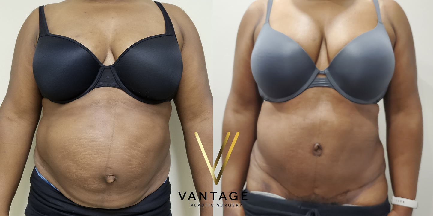 before and after Abdominoplasty