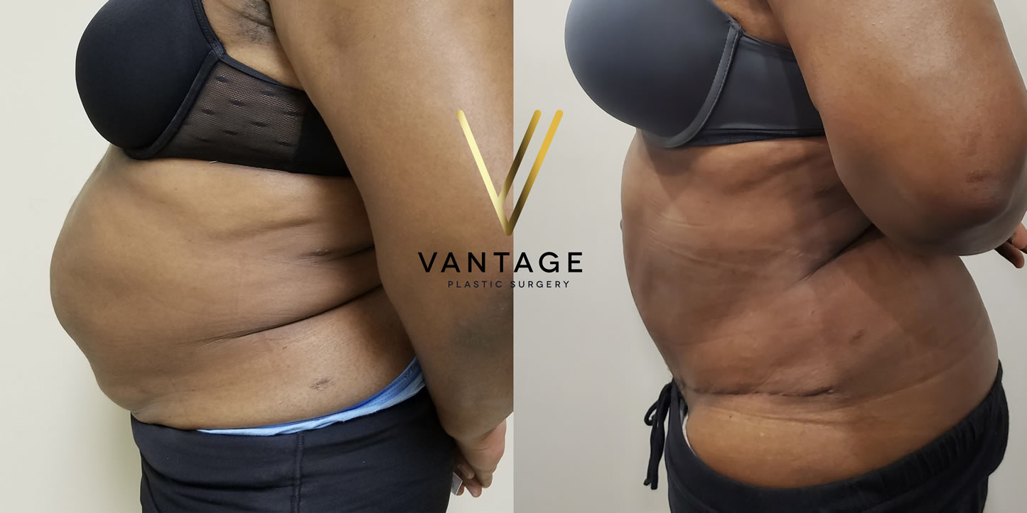 before and after Abdominoplasty