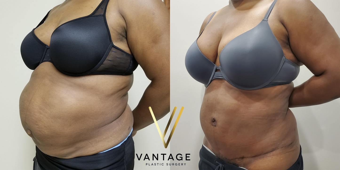 before and after Abdominoplasty