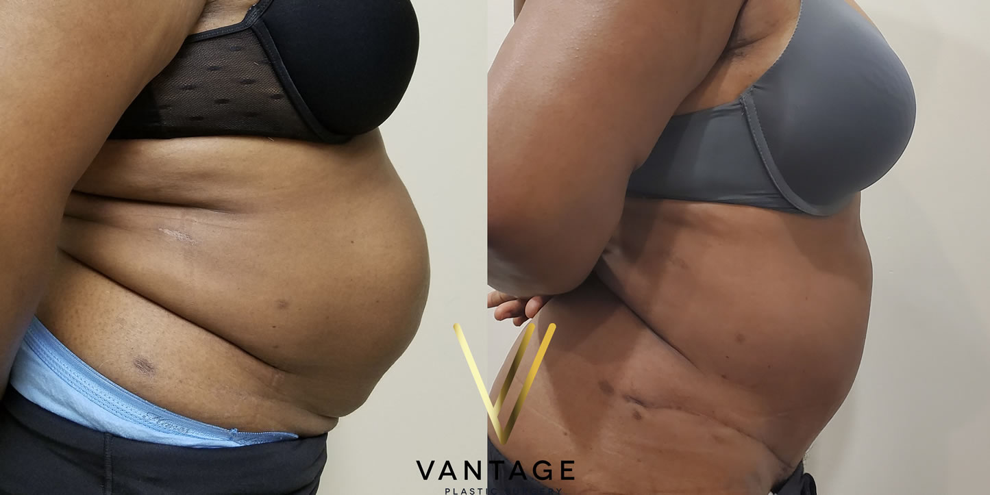 before and after Abdominoplasty