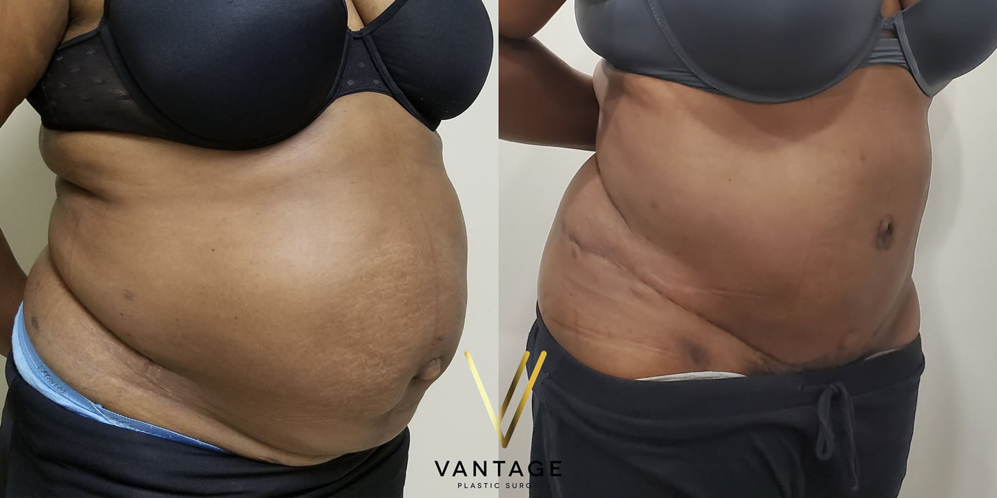 before and after Abdominoplasty