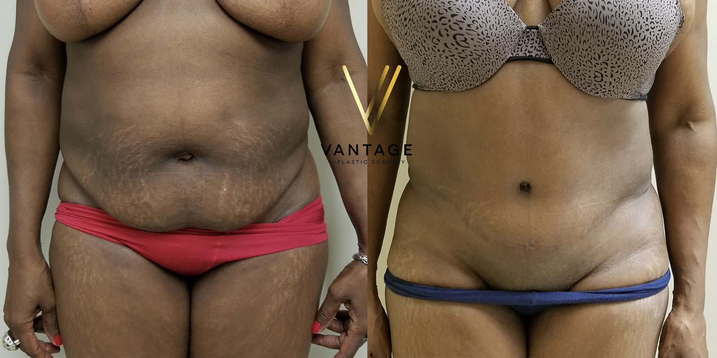 before and after Abdominoplasty