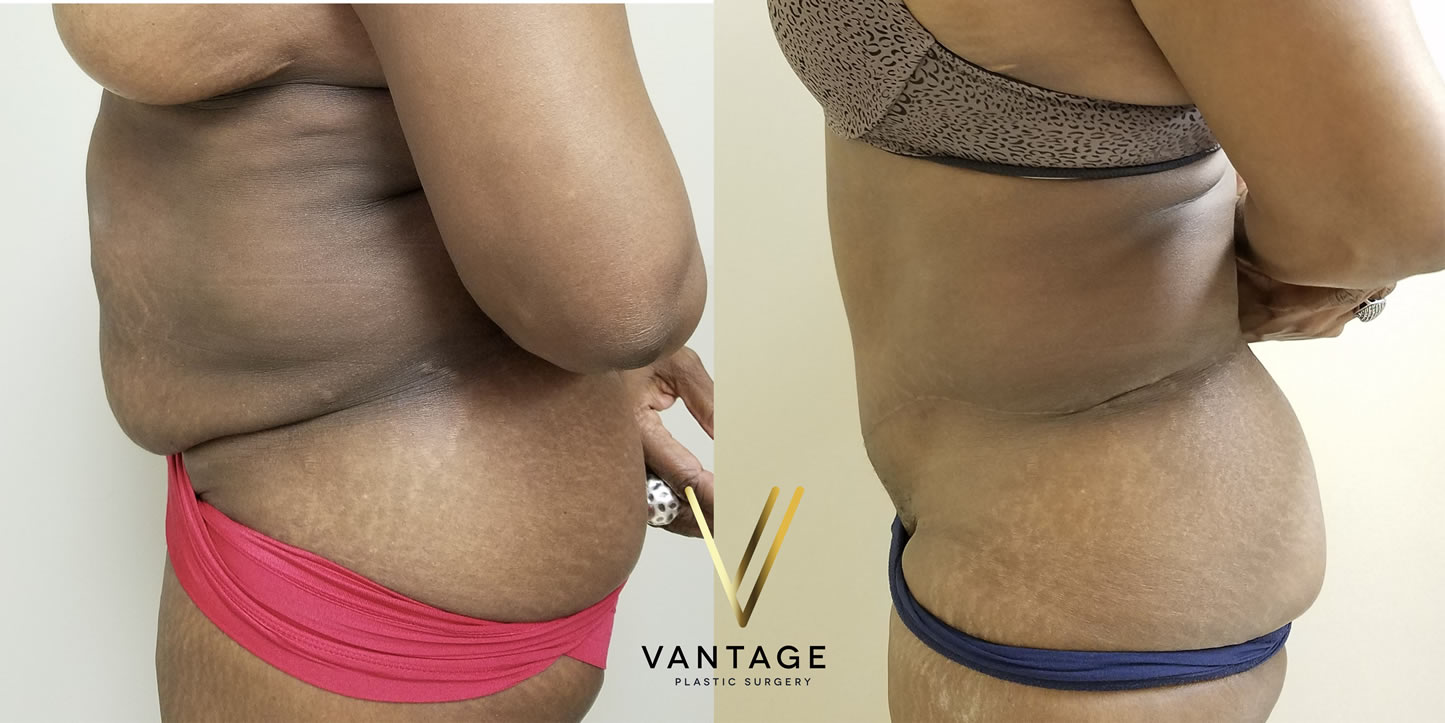 before and after Abdominoplasty