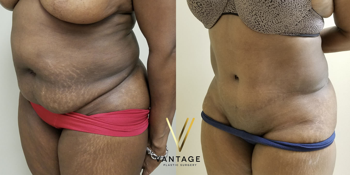 before and after Abdominoplasty