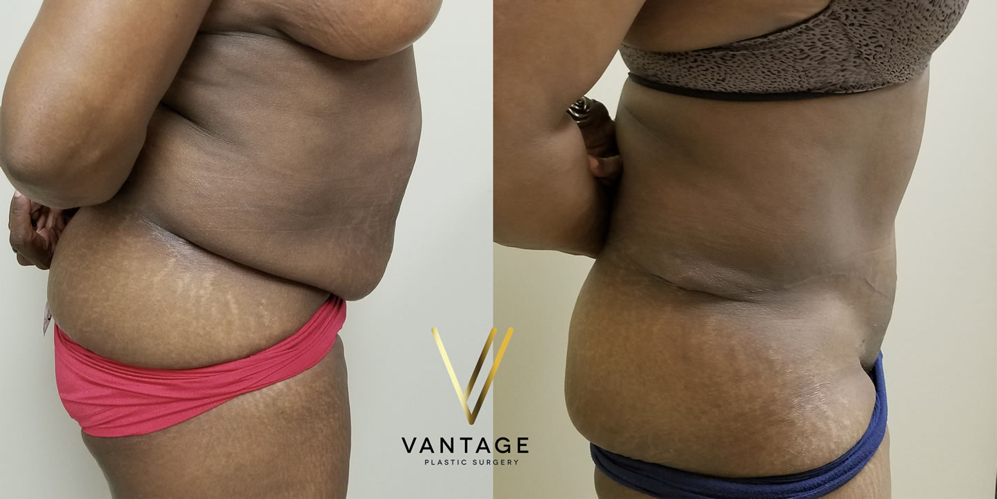 before and after Abdominoplasty