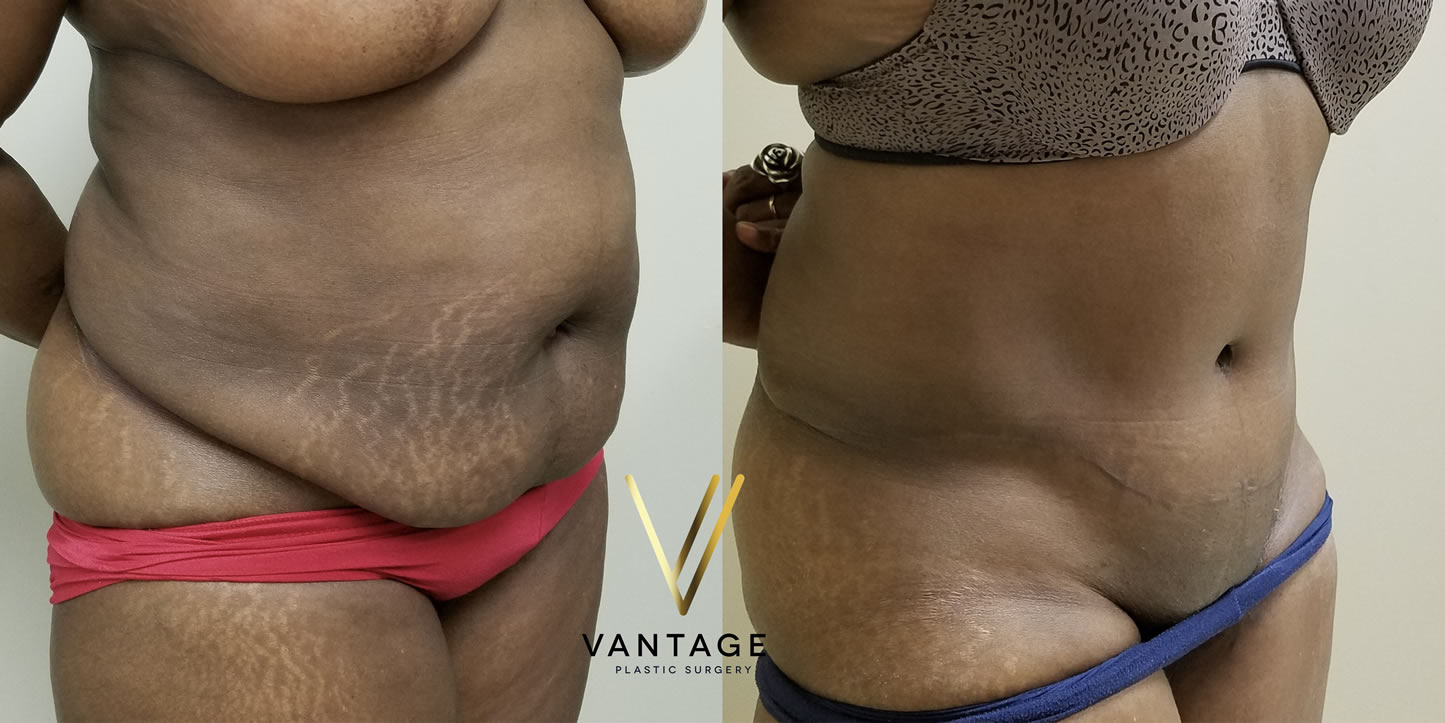 before and after Abdominoplasty