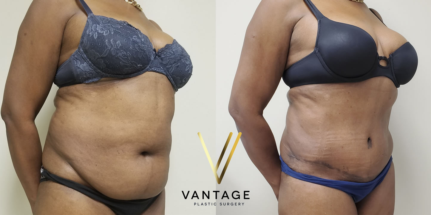 before and after Abdominoplasty