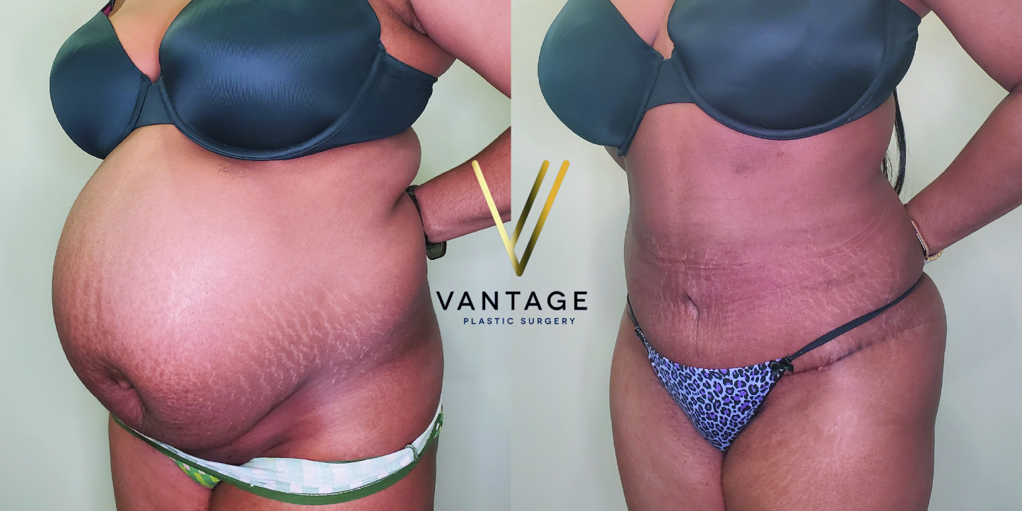 before and after Abdominoplasty