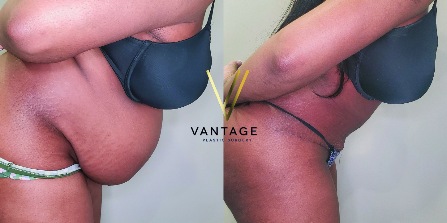 before and after Abdominoplasty